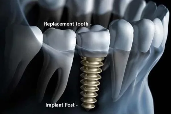 dental implant missing teeth
