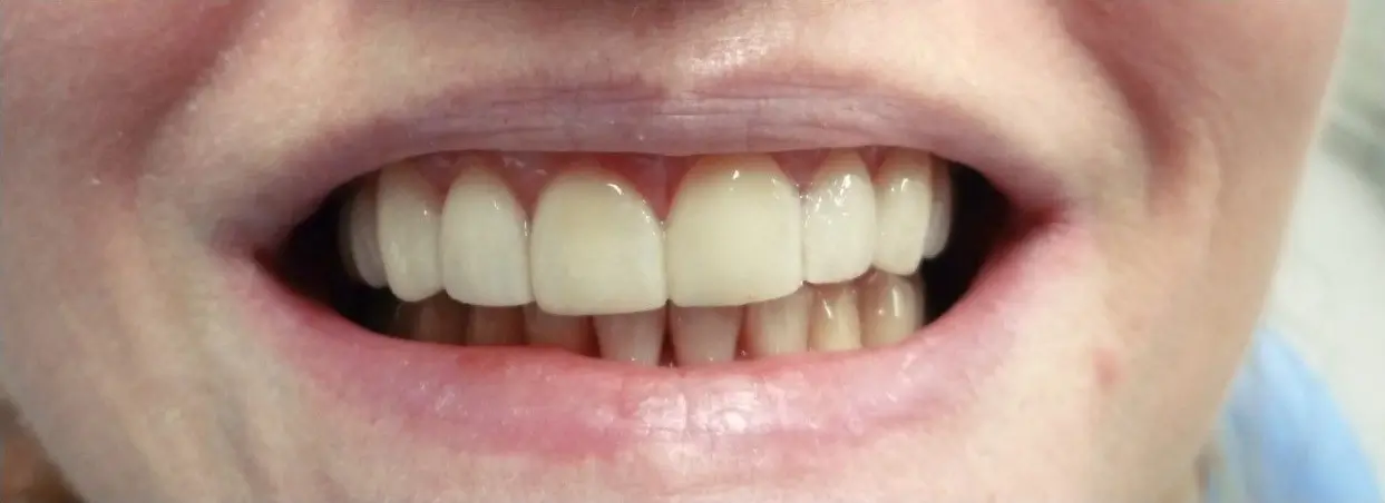 A smile after a dental bonding treatment.