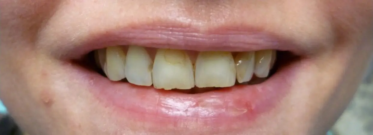 A smile before a dental bonding treatment.