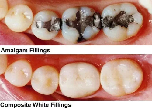 Amalgam vs Composite White Filling Molars side by side comparison
