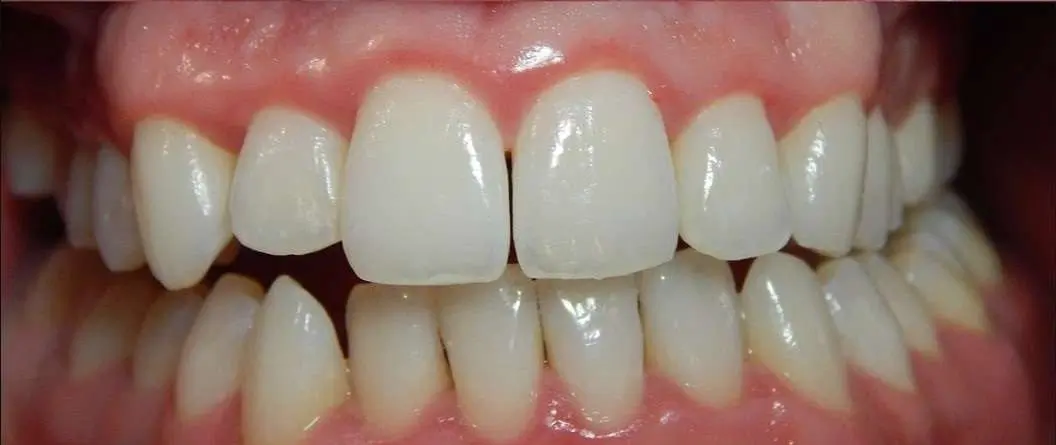 Gum Disease After Treatment Teeth Pic