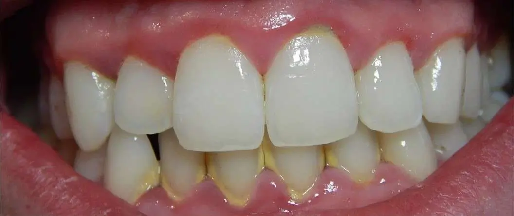 Gum Disease Before Teeth Pic -yellow grime and inflamed gums