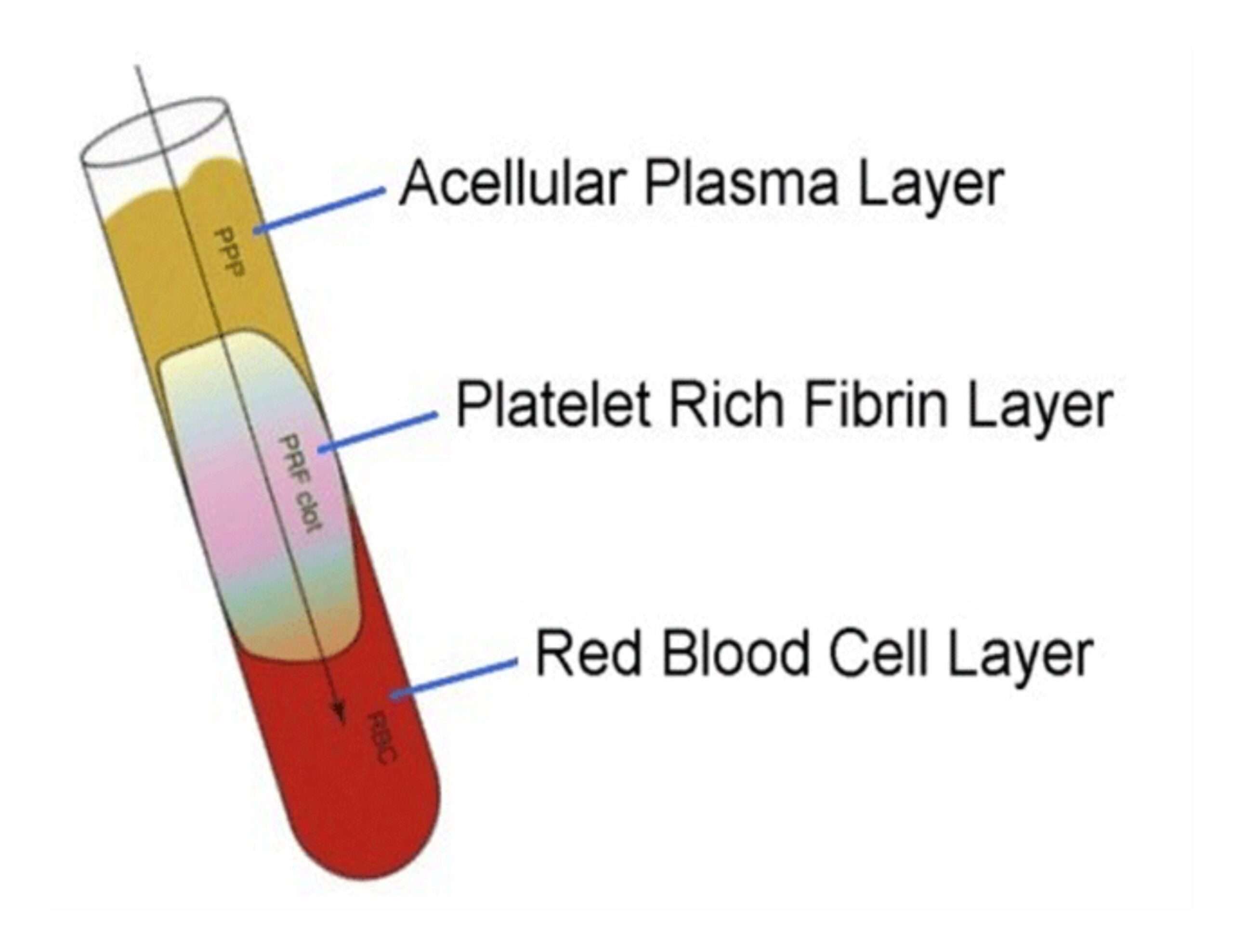 Platelet Rich Fibrin