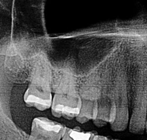 sinust toothache