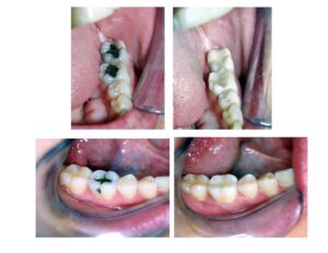 Teeth Whitening/Bleaching