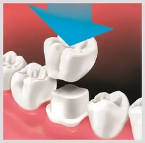 Temporary Solutions for Loose Crowns and Lost Fillings