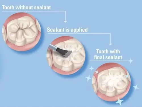 Dental Sealant Process three steps