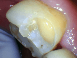 Inside a broken tooth