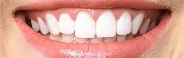 Teeth Whitening After Smile