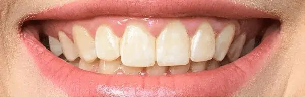 Teeth Whitening Before Smile