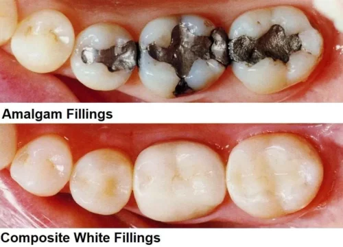 Tooth Fillings Valley Of The Sun Dentistry Glendale AZ